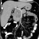 Carcionoid, pancreas, head of pancreas, calcification: CT - Computed tomography